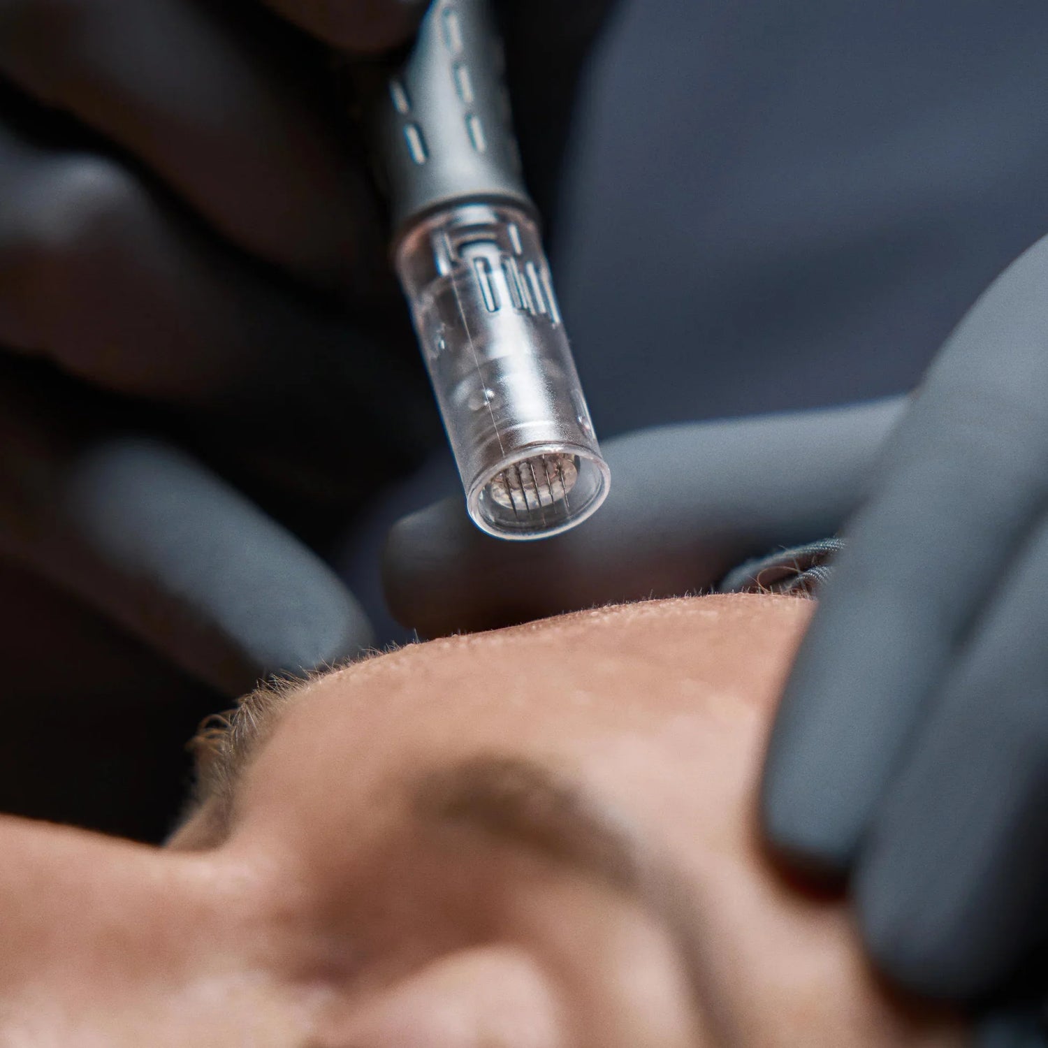 Nanoneedling to supercharge your Skin